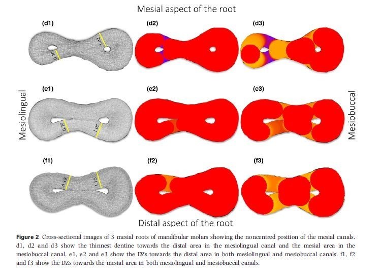 Anatomical Danger Zone Reconsidered: A Micro-CT Study on Dentine Thickness in Mandibular Molars